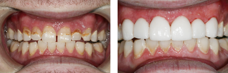 Dental Veneers