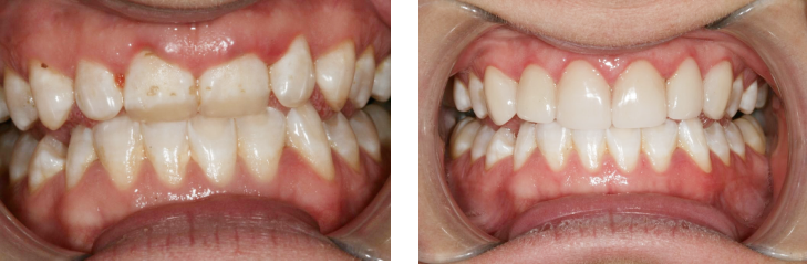 Dental Veneers