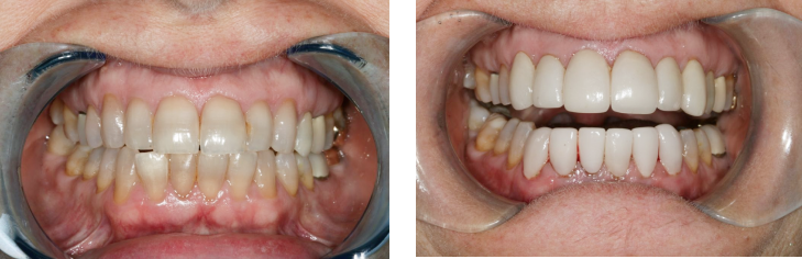 Dental Veneers