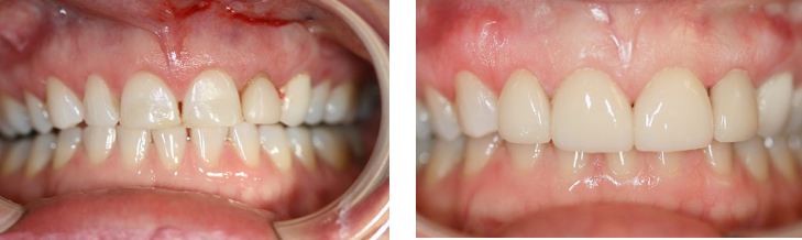 Dental Veneers & Gum Contouring