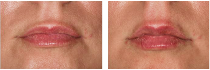 Dermal Filler before and after