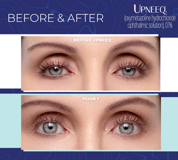 Upneeq eyedrops before and after example on patient